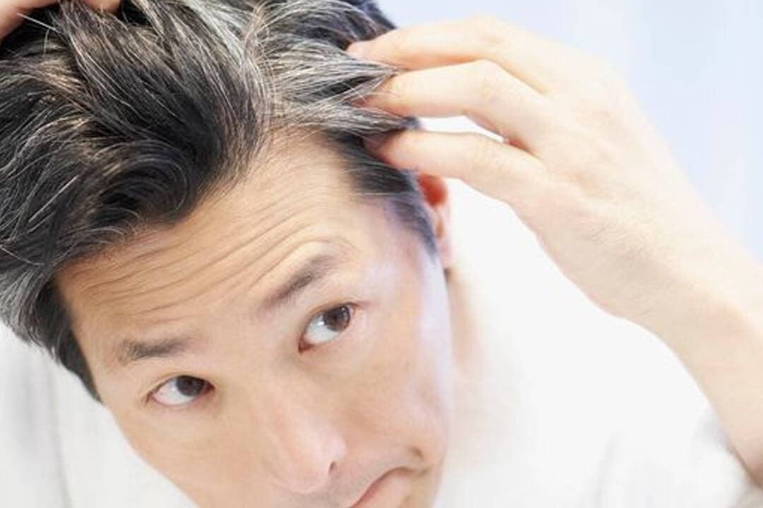 Doctors warn - That reduced melanin causes early graying